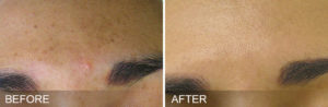 HydraFacial-before-after-BrownSpots