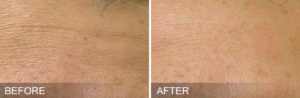 HydraFacial-before-after-FineLines