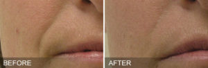 HydraFacial-before-after-NasolabialFolds